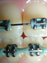 braces close up of braces on teeth