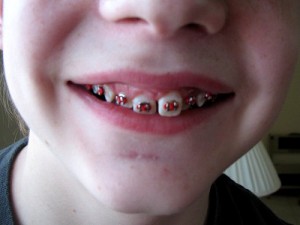 close up picture of boy's mouth with new braces on teeth